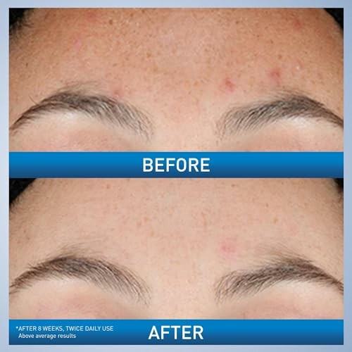 Comparison of skin before and after treatment showing reduced blemishes.